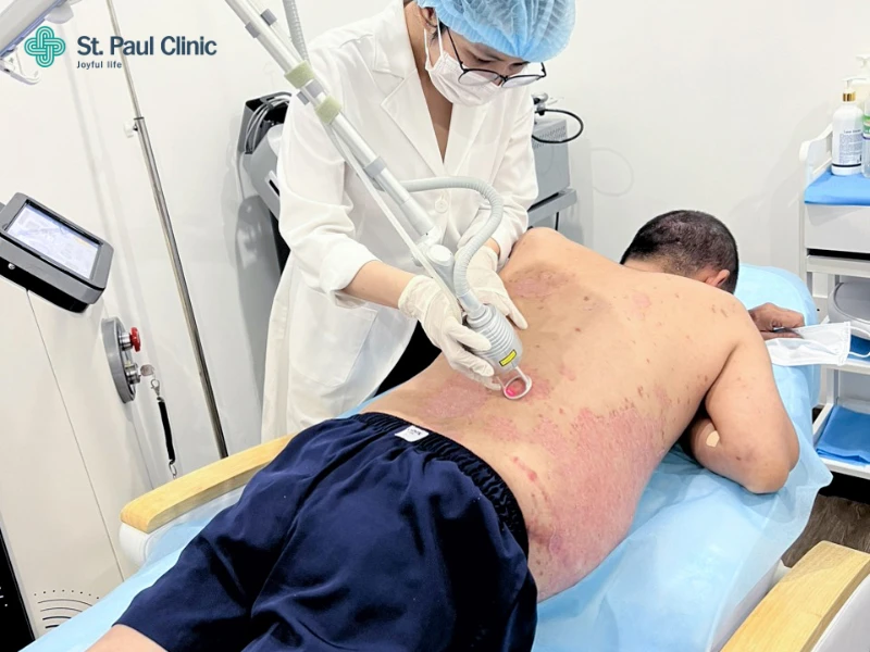 Liệu pháp ánh sáng Excimer E-VN trị vẩy nến có thực sự thần thánh như quảng cáo?