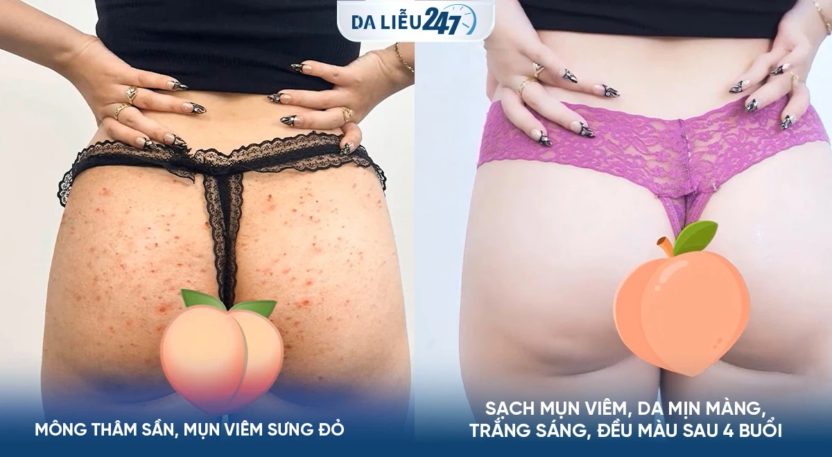 Cuộc sống của tôi đã thay đổi hoàn toàn sau khi điều trị thâm sạm tại Da Liễu 247