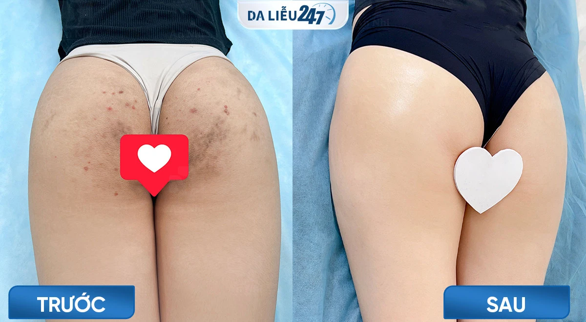 Cuộc sống của tôi đã thay đổi hoàn toàn sau khi điều trị thâm sạm tại Da Liễu 247