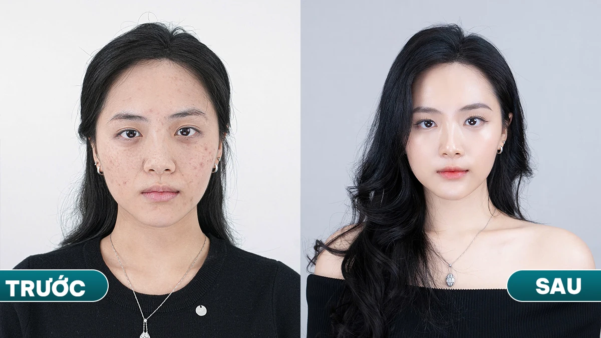 SỞ HỮU VẺ ĐẸP HOÀN MỸ CHỈ BẰNG PHƯƠNG PHÁP PRP PREMIUM
